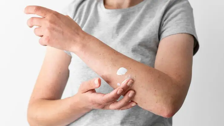 Mpox: Dermatologista explica os principais sintomas na pele e esclarece dúvidas sobre as lesões cutâneas