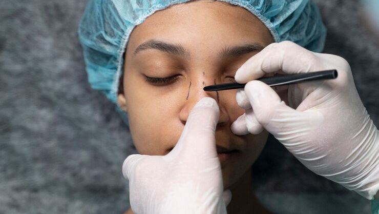 Especialista explica a rinoplastia 360º e destaca os resultados mais harmônicos