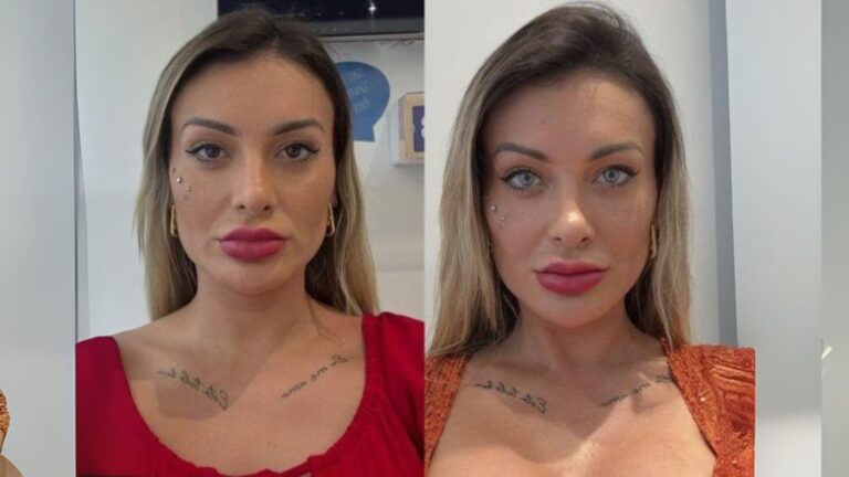 Queratopigmentação: especialista alerta para riscos da cirurgia estética nos olhos