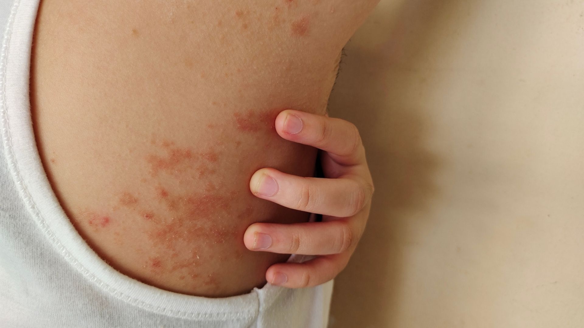 Janeiro Roxo alerta para avanço da hanseníase e importância do diagnóstico precoce